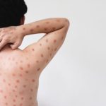 Mpox em Minas Gerais: avanço no controle da doença reforça importância da vigilância em saúde