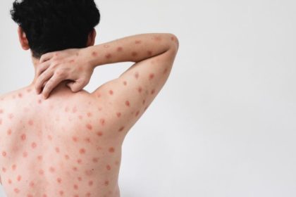 Mpox em Minas Gerais: avanço no controle da doença reforça importância da vigilância em saúde